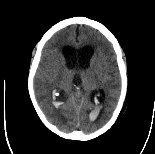 File:Cerebellar hemorrhage causing obstructive hydrocephalus (Radiopaedia 33989-35207 Axial non-contrast 26).jpg