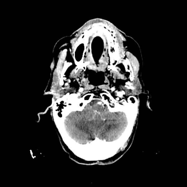File:Cerebellar metastasis - lung tumor (Radiopaedia 69317-79145 Axial with contrast 6).jpg