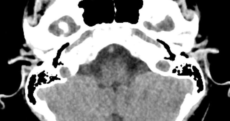 File:Cerebellopontine angle lipoma (Radiopaedia 57303-64242 B 22).jpg