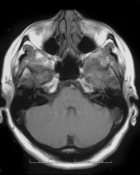 File:Cerebellopontine angle meningioma (Radiopaedia 2597-6293 Axial T1 1).jpg