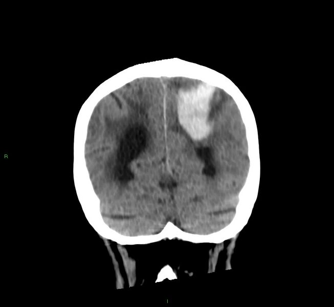 File:Cerebral amyloid angiopathy-associated lobar intracerebral hemorrhage (Radiopaedia 58530-65688 Coronal non-contrast 19).jpg