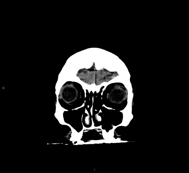 File:Cerebral amyloid angiopathy-associated lobar intracerebral hemorrhage (Radiopaedia 58560-65723 Coronal non-contrast 60).jpg