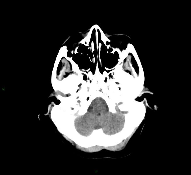 File:Cerebral amyloid angiopathy-associated lobar intracerebral hemorrhage (Radiopaedia 58751-65972 Axial non-contrast 42).jpg