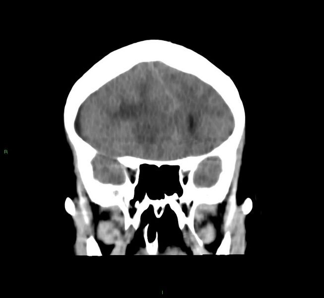 File:Cerebral amyloid angiopathy-associated lobar intracerebral hemorrhage (Radiopaedia 58751-65972 Coronal non-contrast 43).jpg