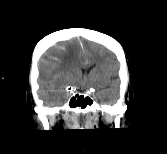 File:Cerebral amyloid angiopathy-associated lobar intracerebral hemorrhage (Radiopaedia 58756-65977 Coronal non-contrast 41).jpg