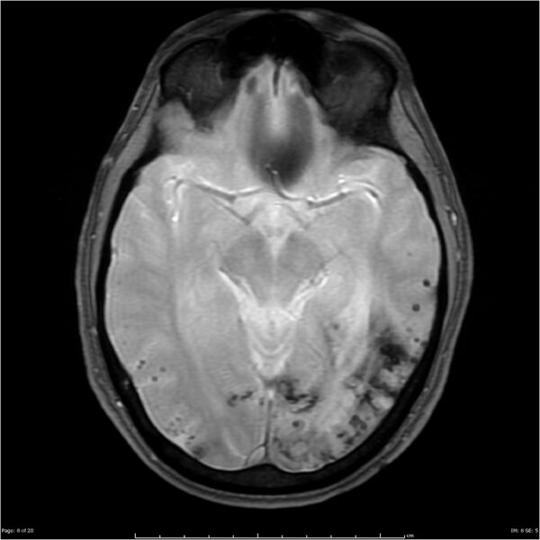 File:Cerebral amyloid angiopathy (Radiopaedia 4561-6683 Axial Gradient Echo 3).jpg