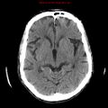 Cerebral and orbital tuberculomas (Radiopaedia 13308-13310 Axial non-contrast 32).jpg