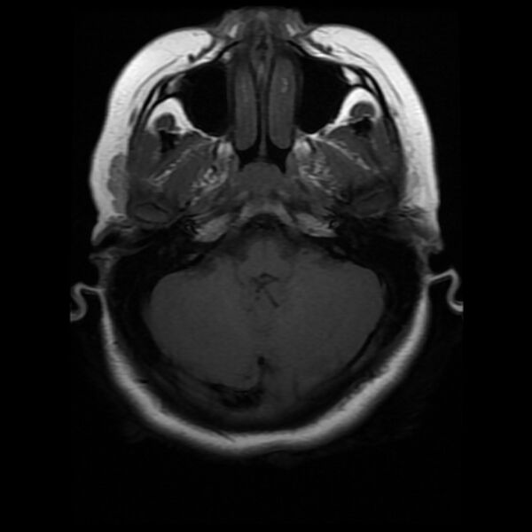 File:Cerebral cavernous malformation (Radiopaedia 44301-47942 Axial T1 5).jpg