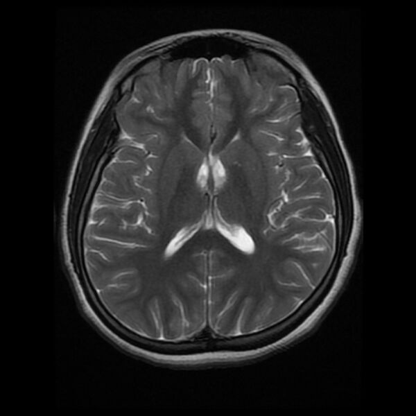 File:Cerebral cavernous malformation (Radiopaedia 44301-47942 Axial T2 12).jpg