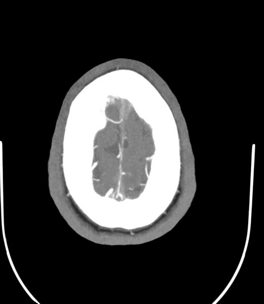File:Cerebral dural venous sinus thrombosis (Radiopaedia 86514-102576 A 86).jpg