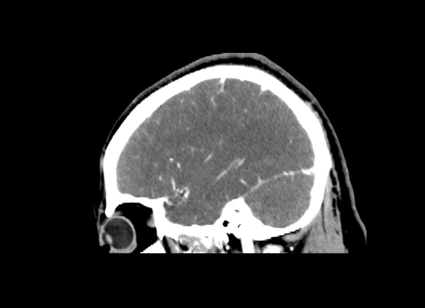 Cerebral edema (Radiopaedia 82519-96661 D 39).jpg