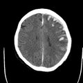 Cerebral hemorrhagic contusions (Radiopaedia 23145-23188 Axial non-contrast 27).jpg