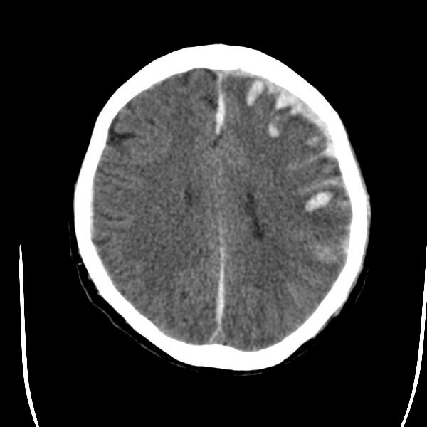File:Cerebral hemorrhagic contusions (Radiopaedia 23145-23188 Axial non-contrast 27).jpg