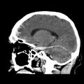 Cerebral hemorrhagic contusions (Radiopaedia 23145-23188 C 17).jpg