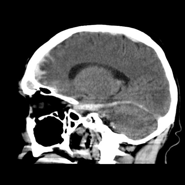 File:Cerebral hemorrhagic contusions (Radiopaedia 23145-23188 C 17).jpg