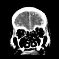 Cerebral hemorrhagic contusions (Radiopaedia 23145-23188 Coronal non-contrast 10).jpg