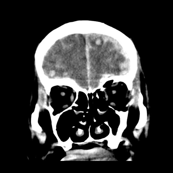 File:Cerebral hemorrhagic contusions (Radiopaedia 23145-23188 Coronal non-contrast 10).jpg