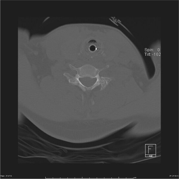 File:Cerebral hemorrhagic contusions and cervical spine fractures (Radiopaedia 32865-33841 C 24).jpg