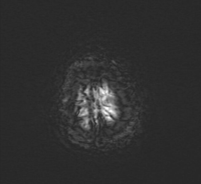 File:Cerebral venous thrombosis (Radiopaedia 71207-81504 Axial SWI 53).jpg