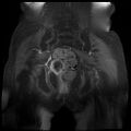 Cervical carcinoma (Radiopaedia 78847-91705 J 12).jpg