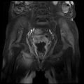Cervical carcinoma (Radiopaedia 78847-91705 J 9).jpg