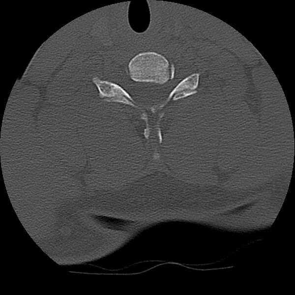 File:Cervical flexion teardrop fracture with cord hemorrhage (Radiopaedia 32497-33454 Axial bone window 62).jpg