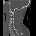 Cervical flexion teardrop fracture with cord hemorrhage (Radiopaedia 32497-33454 Sagittal bone window 28).jpg