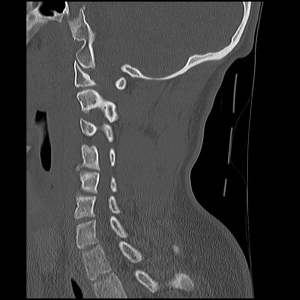 File:Cervical flexion teardrop fracture with cord hemorrhage (Radiopaedia 32497-33454 Sagittal bone window 28).jpg