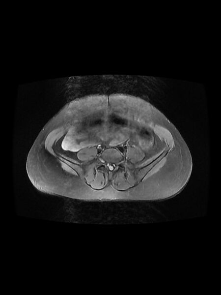 File:Cesarean section scar endometrioma (Radiopaedia 56569-63297 Axial PD fat sat 5).jpg