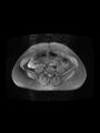 Cesarean section scar endometrioma (Radiopaedia 56569-63297 Axial PD fat sat 5).jpg