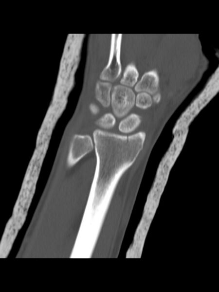 File:Chauffeur's (Hutchinson) fracture (Radiopaedia 58043-65079 Coronal bone window 8).jpg
