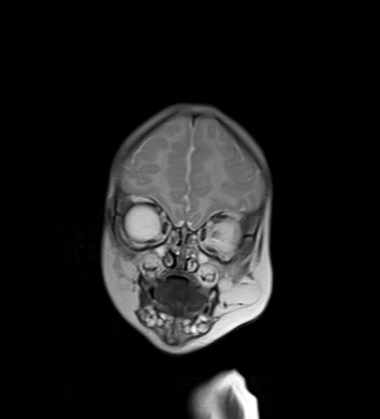 File:Chiari III malformation with occipital encephalocele (Radiopaedia 79446-92559 Coronal T2 28).jpg