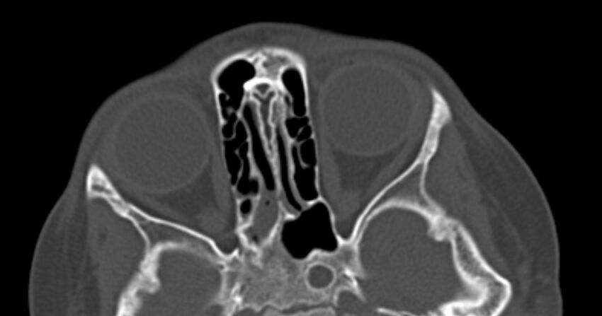Choanal atresia (Radiopaedia 51295-56972 Axial bone window 45).jpg