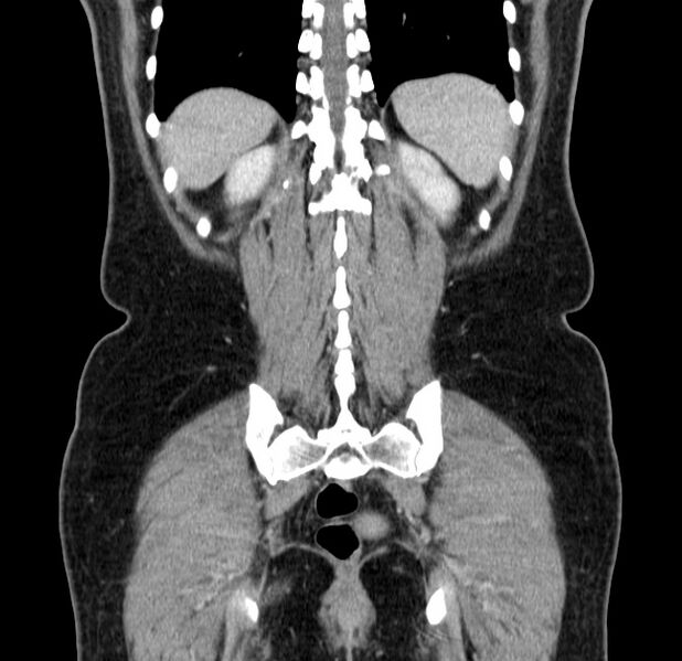 File:Choledocholithiasis on CT and MRI (Radiopaedia 24825-25087 C 43).jpg