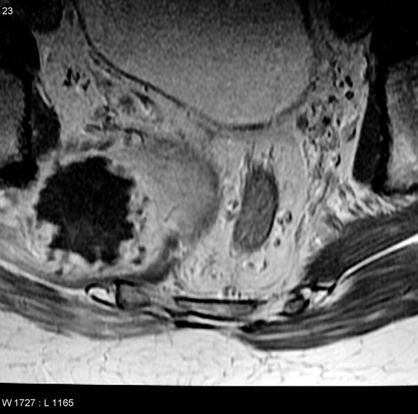 File:Chondrosarcoma - sacrum (Radiopaedia 6173-7627 Axial T1 C+ 9).jpg