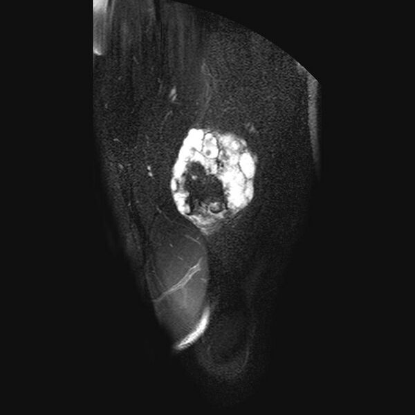 File:Chondrosarcoma arising from exostosis (Radiopaedia 59996-67686 C 4).jpg