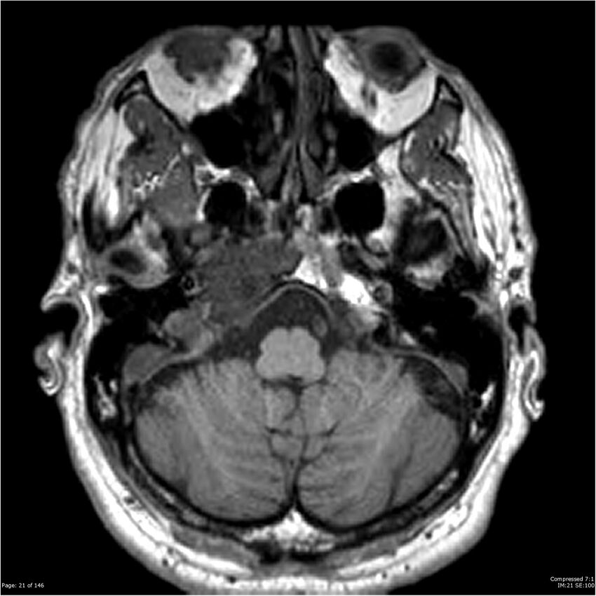 Chondrosarcoma of skull base- grade II (Radiopaedia 40948-43654 Axial T1 21).jpg