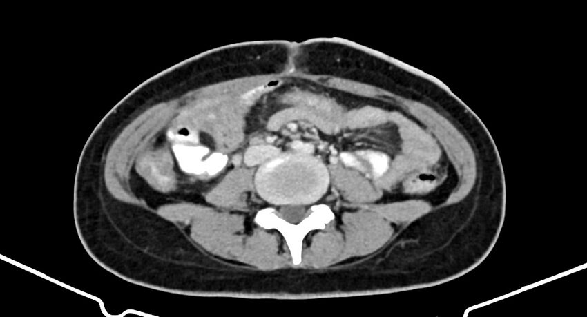 Choriocarcinoma liver metastases (Radiopaedia 74768-85766 A 126).jpg