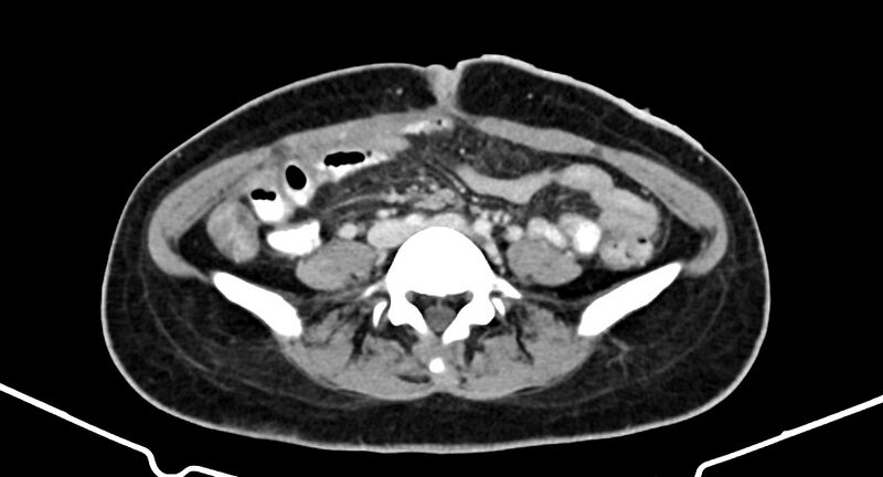 File:Choriocarcinoma liver metastases (Radiopaedia 74768-85766 A 135).jpg
