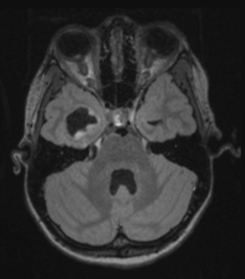 Choroid plexus carcinoma (Radiopaedia 91013-108553 Axial FLAIR C+ 101).jpg