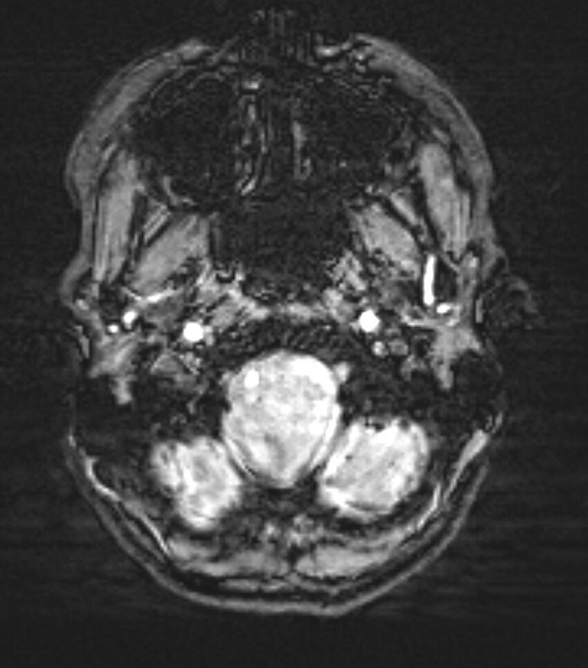 Choroid plexus carcinoma (Radiopaedia 91013-108553 Axial SWI 10).jpg