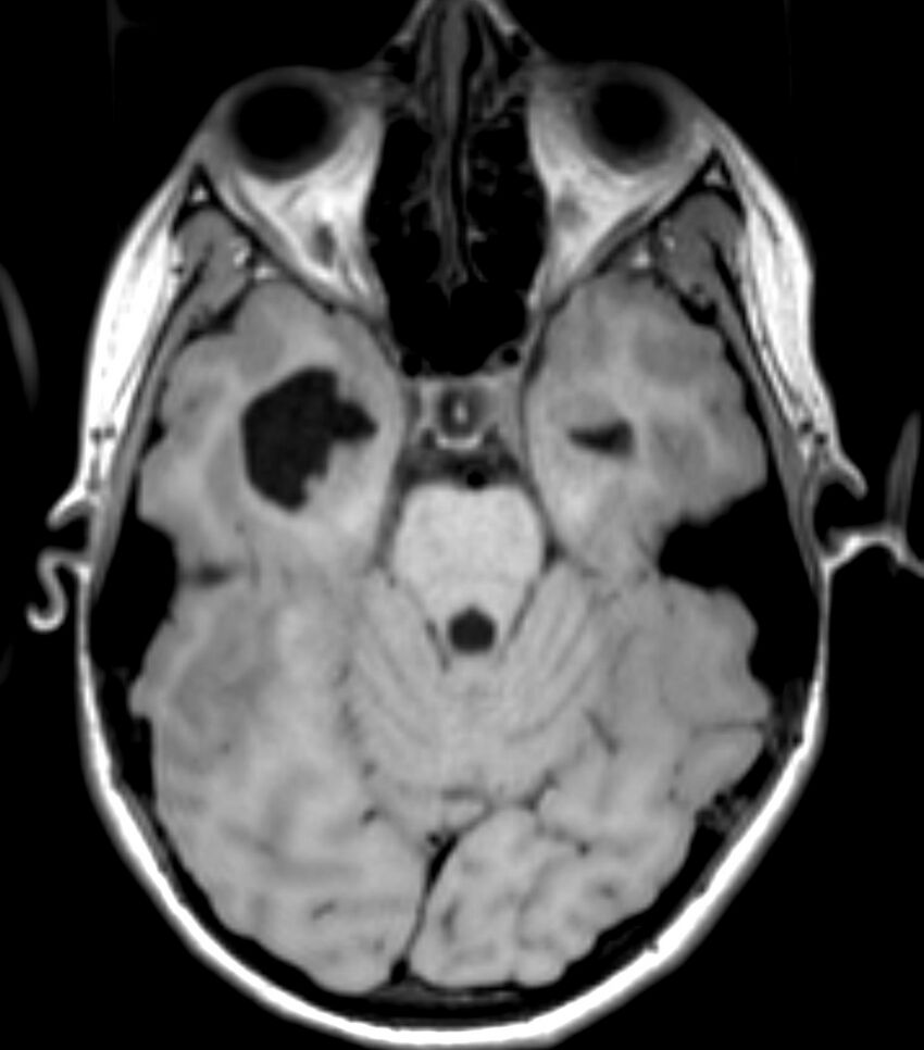 Choroid plexus carcinoma (Radiopaedia 91013-108553 Axial T1 64).jpg