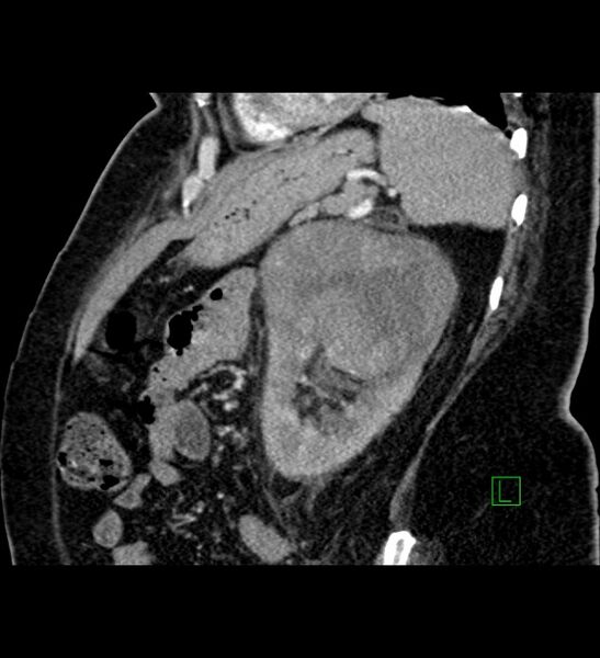 File:Chromophobe renal cell carcinoma (Radiopaedia 84239-99519 D 35).jpg
