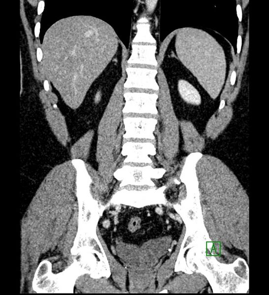 File:Chromophobe renal cell carcinoma (Radiopaedia 84286-99573 H 126).jpg