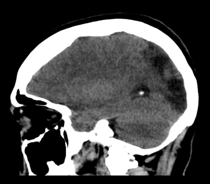 File:Chronic bilateral occipital lobe infarcts (Radiopaedia 31276-31996 C 27).jpg