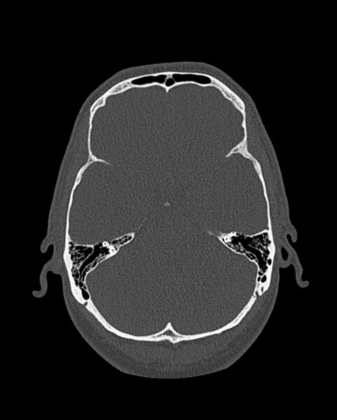 File:Chronic maxillary sinusitis caused by a foreign body (Radiopaedia 58521-65676 Axial bone window 282).jpg