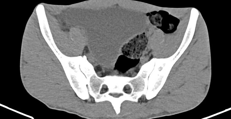File:Chronic osteomyelitis (with sequestrum) (Radiopaedia 74813-85822 D 12).jpg