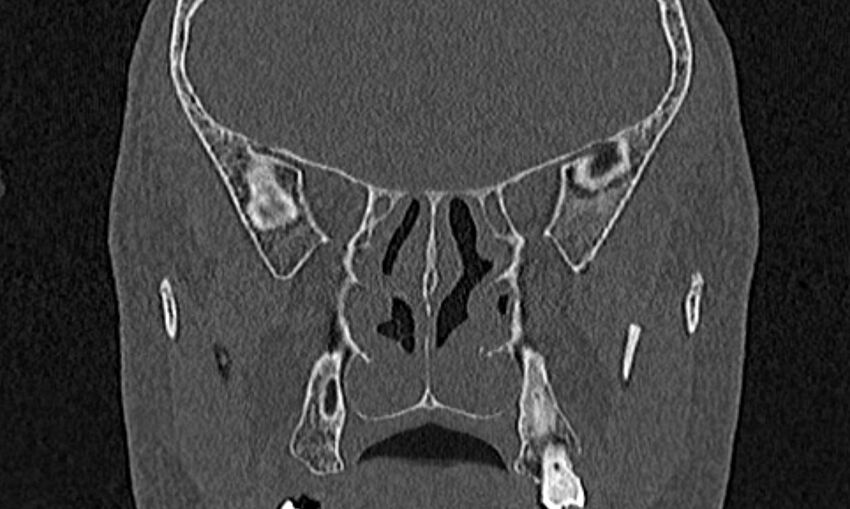 Chronic rhinosinusitis (Radiopaedia 65079-74075 Coronal bone window 56).jpg