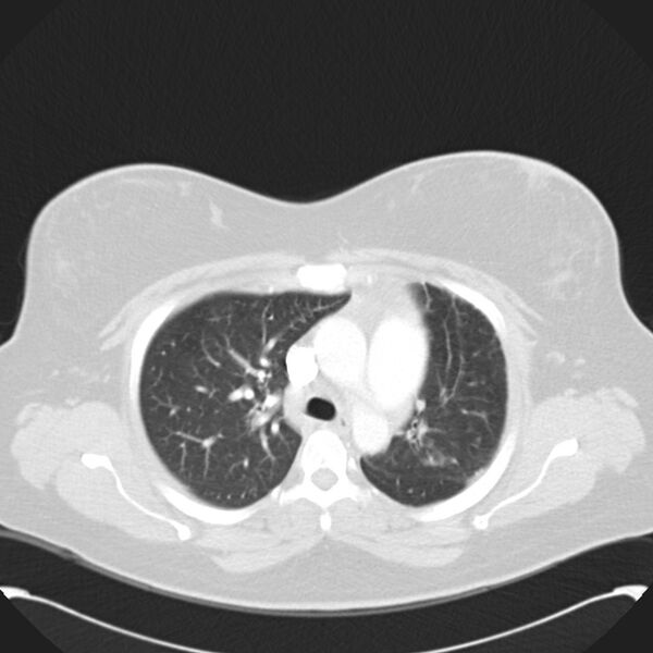 File:Chronic thromboembolic pulmonary hypertension (CTEPH) (Radiopaedia 74597-85531 Axial lung window 18).jpg