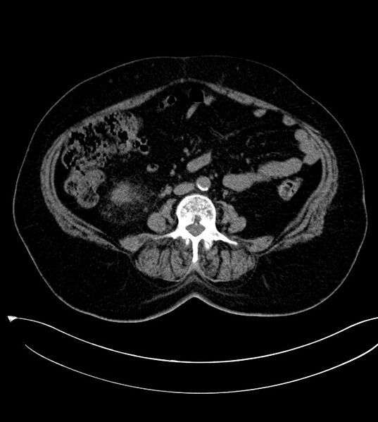 File:Clear cell renal cell carcinoma (Radiopaedia 85004-100537 Axial non-contrast 26).jpg